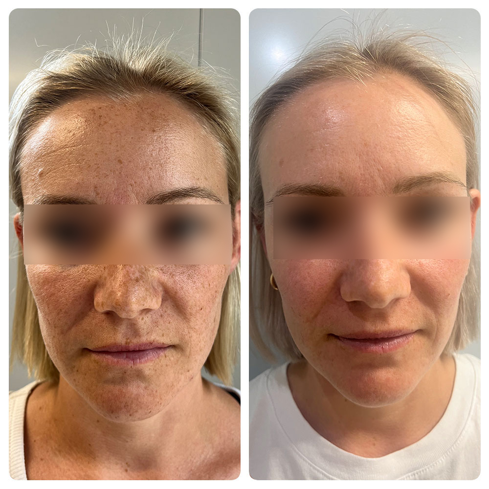 Skin Hero NZ - Cosmetic Clinic Laser Anti Wrinkle Injections