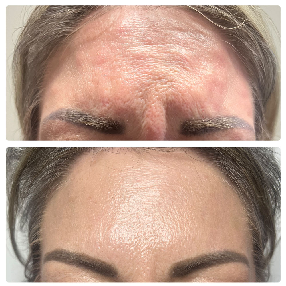 Skin Hero Botox® Treatment before and after