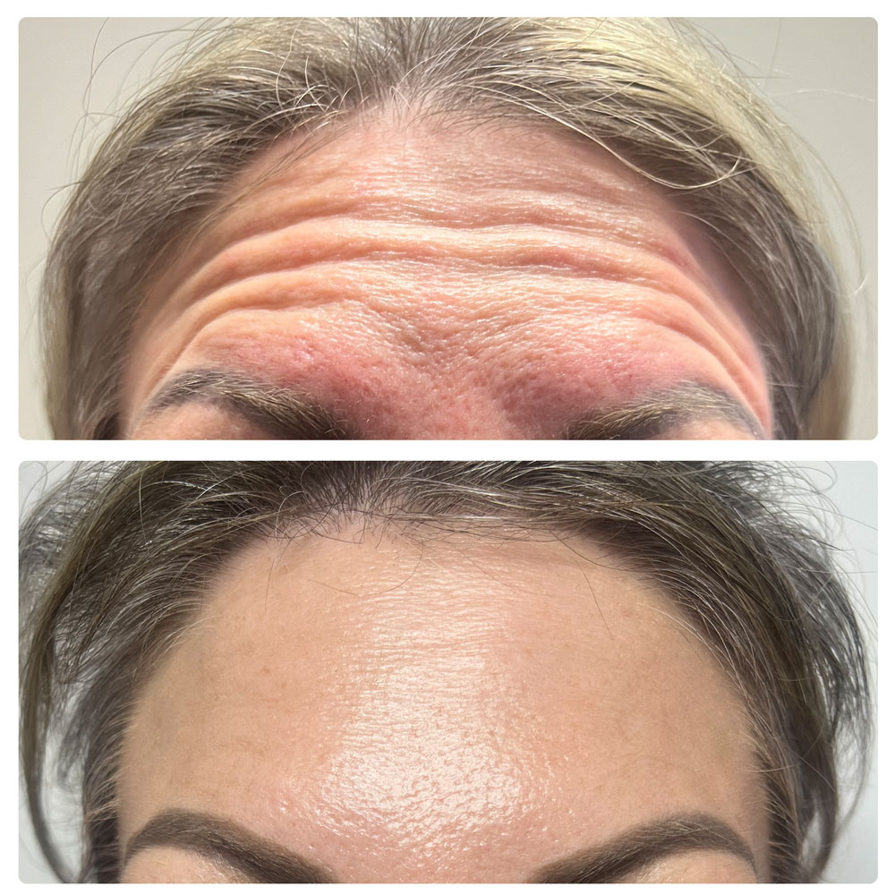 Skin Hero Botox® Treatment before and after