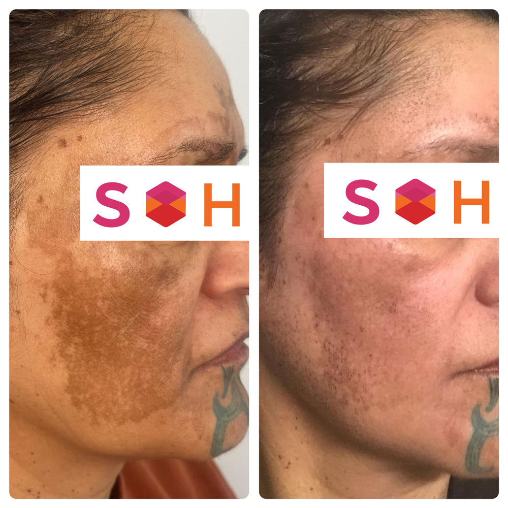 Skin Hero Moxi LAser Treatment